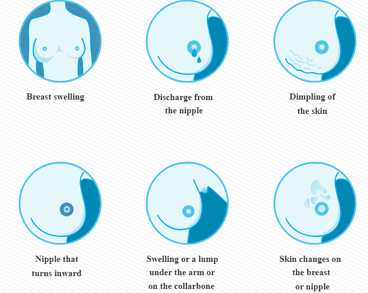 Symptoms of breast cancer